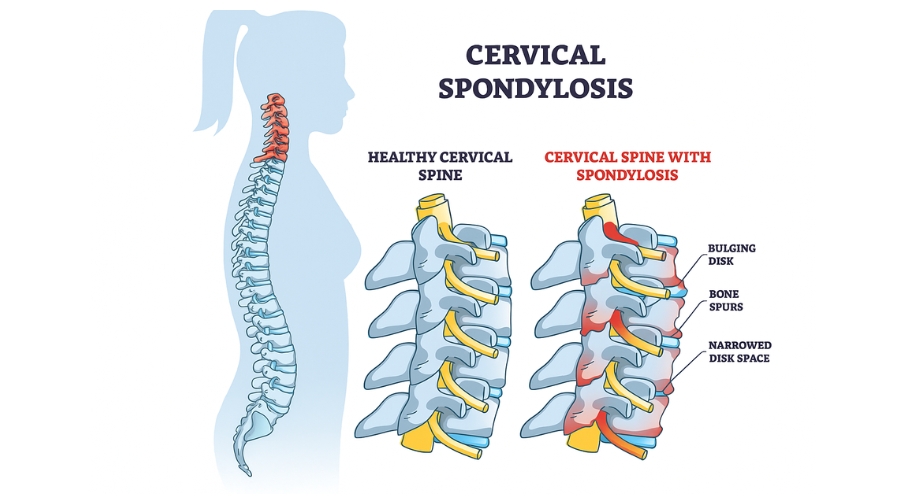 cervical spondylosis doctor