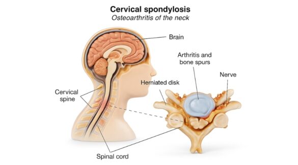 Cervical Spondylosis