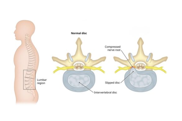 Slip Disc Treatment in Mumbai