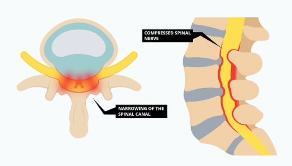 Spinal Stenosis