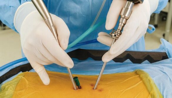 Endoscopic Spine Surgery in Mumbai