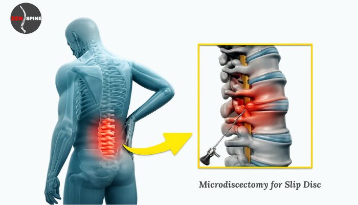Microdiscectomy for Slip Disc