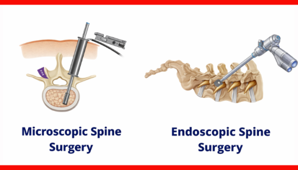 Endoscopic vs Microscopic Spine Surgery
