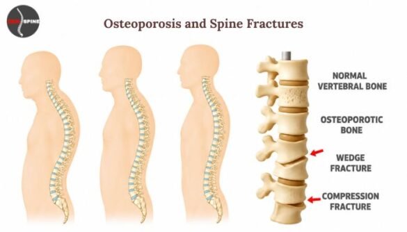 Osteoporosis and Spine Fractures: Risks, Prevention & Treatment